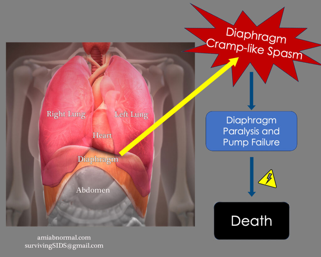 Proposed SIDS mechanism by Dr. Gebien.  Diaphragm cramp induces a state equivalent to diaphragmatic paralysis which shuts down respiration.  Also thought to occur in older children and adults.  